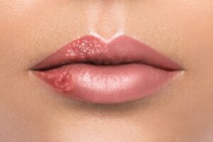 Lippenherpes